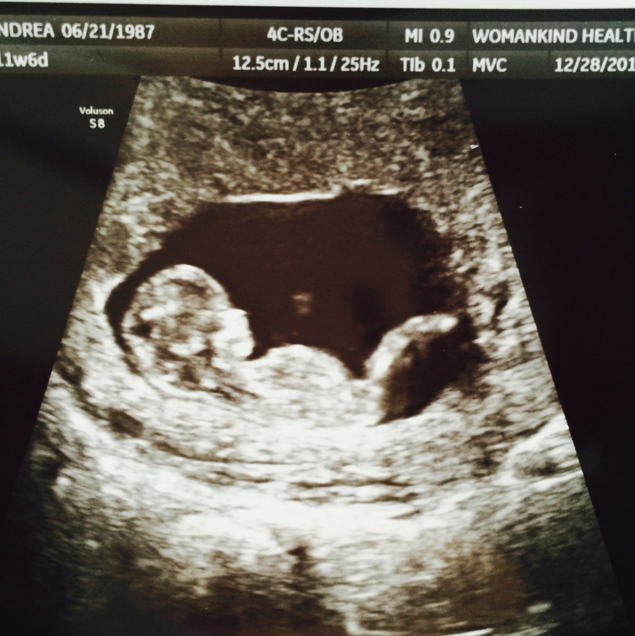 11 Week Pregnant Ultrasound