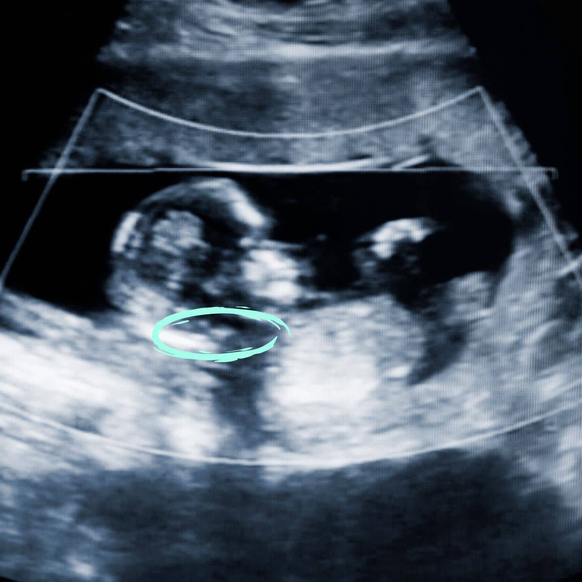 13 Weeks Pregnant Ultrasound