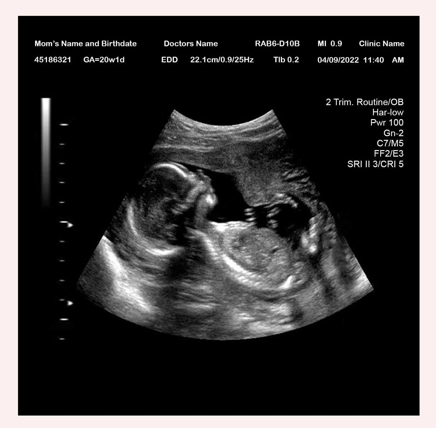 19 Week Ultrasound