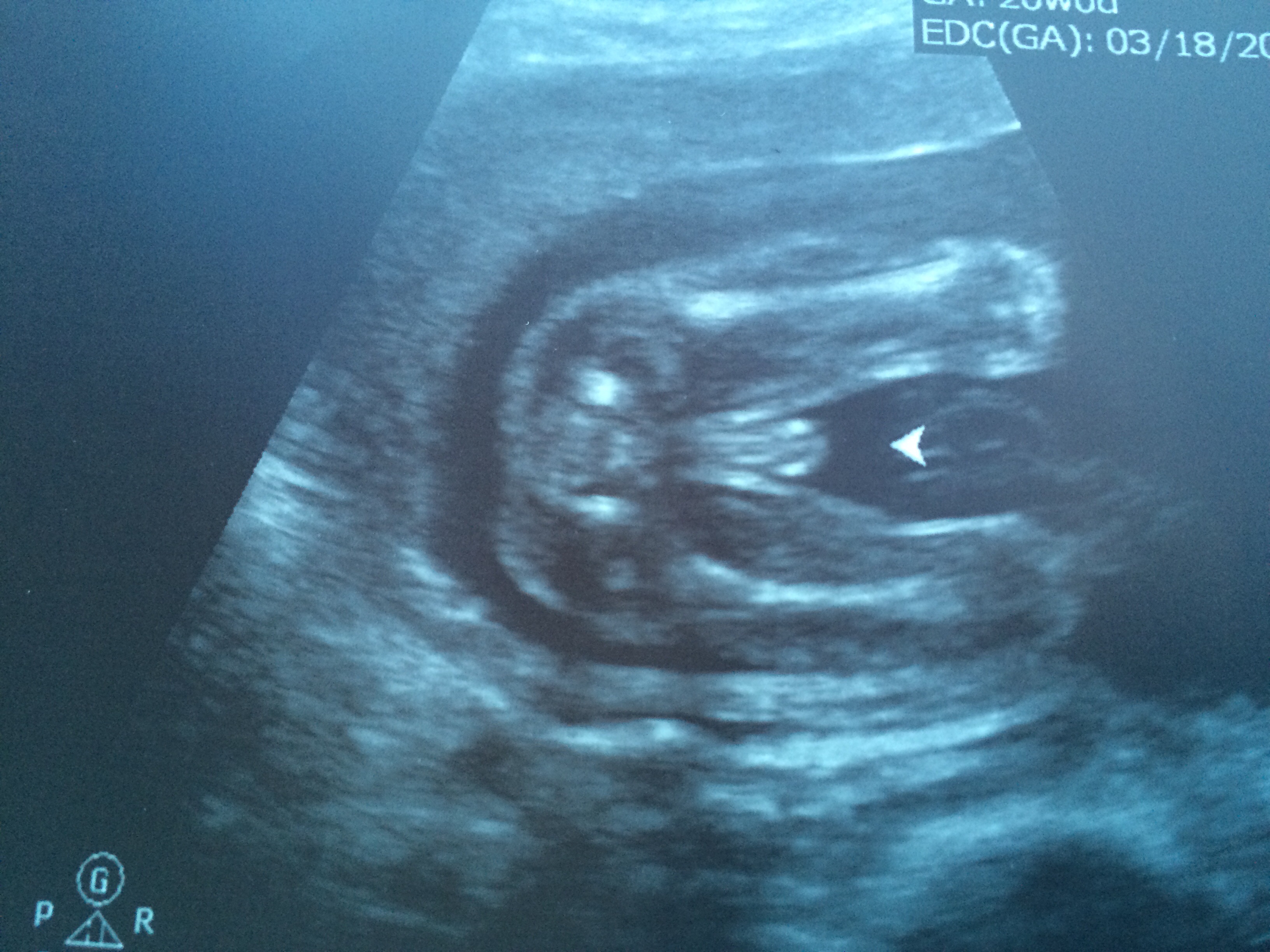 20 Weeks Pregnant Ultrasound