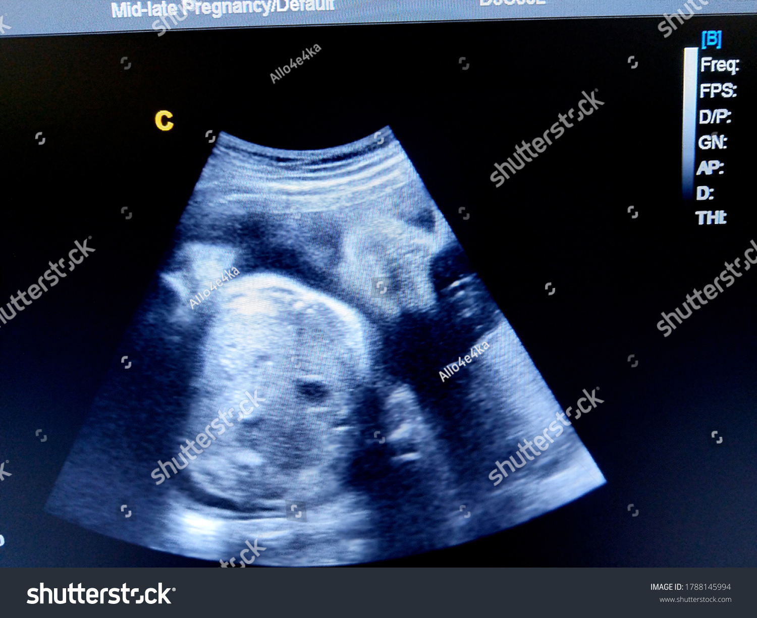 36 Weeks Sonography