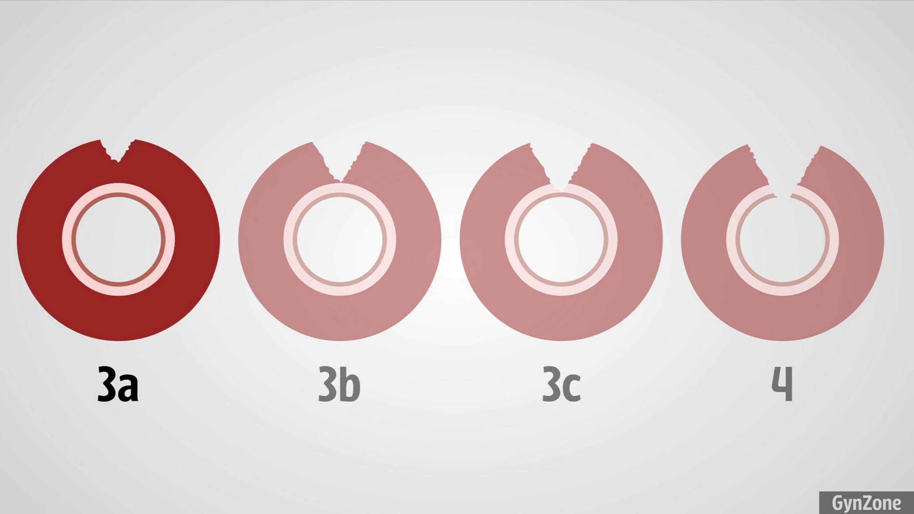 3Rd Degree Tear Childbirth