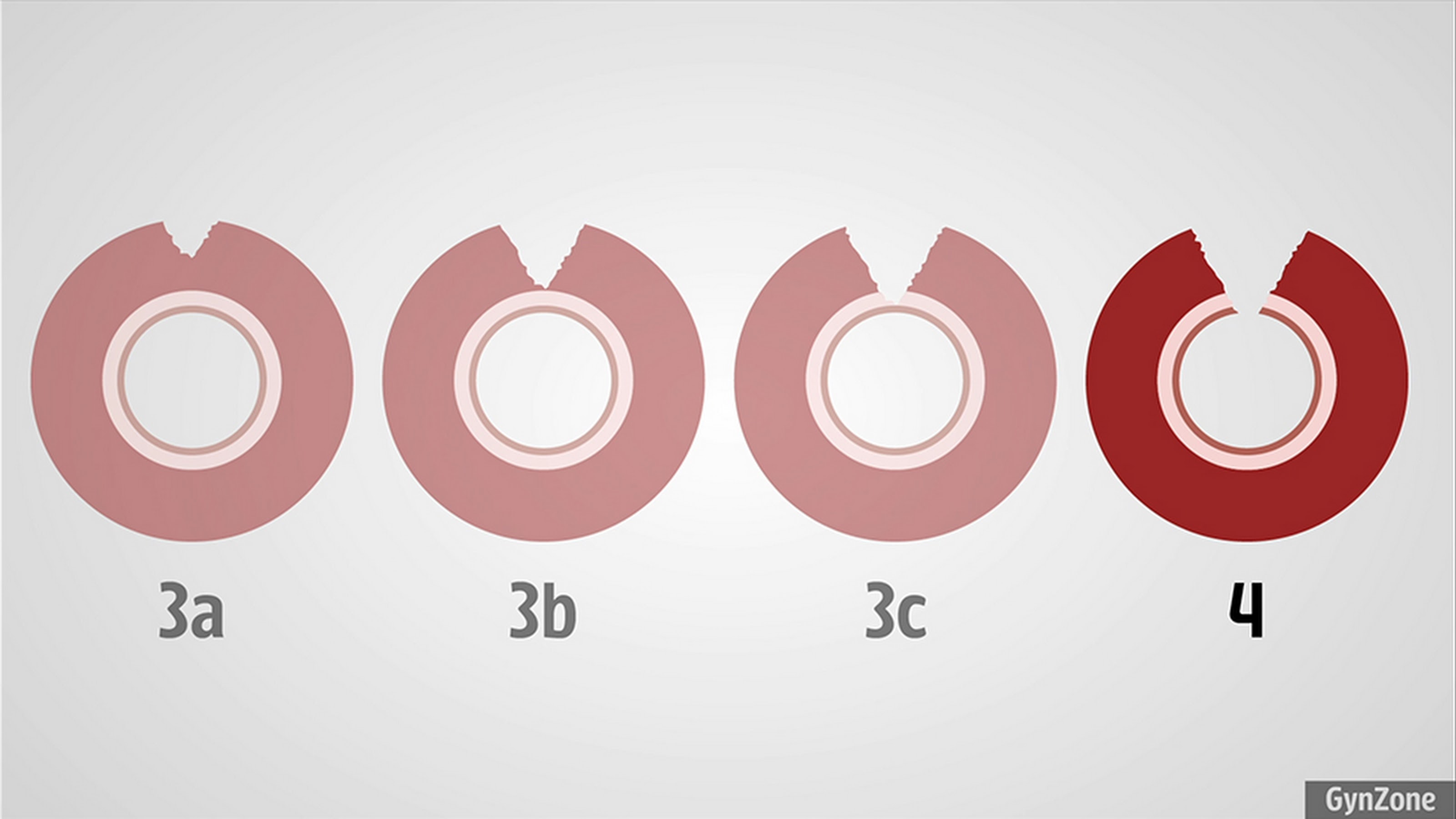 4Th Degree Tear Childbirth