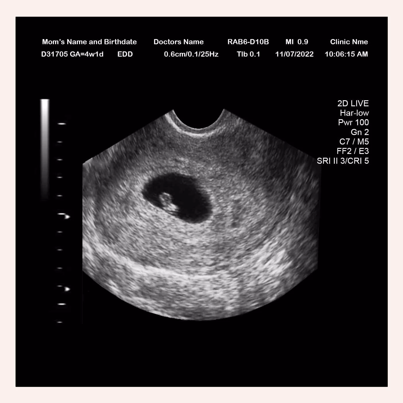 5 Week Pregnancy Report