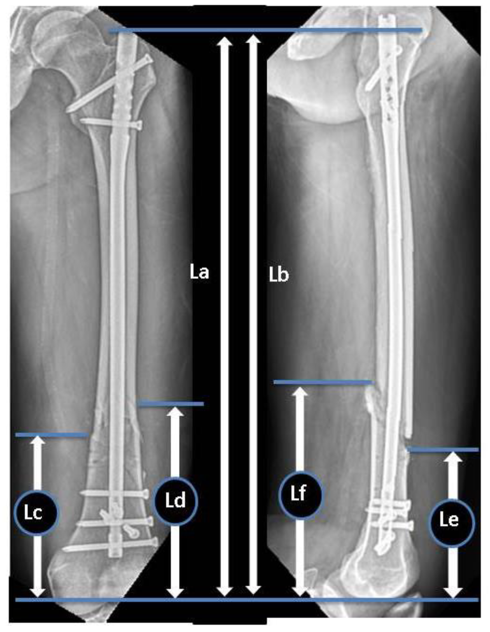 Abbreviation For Fracture