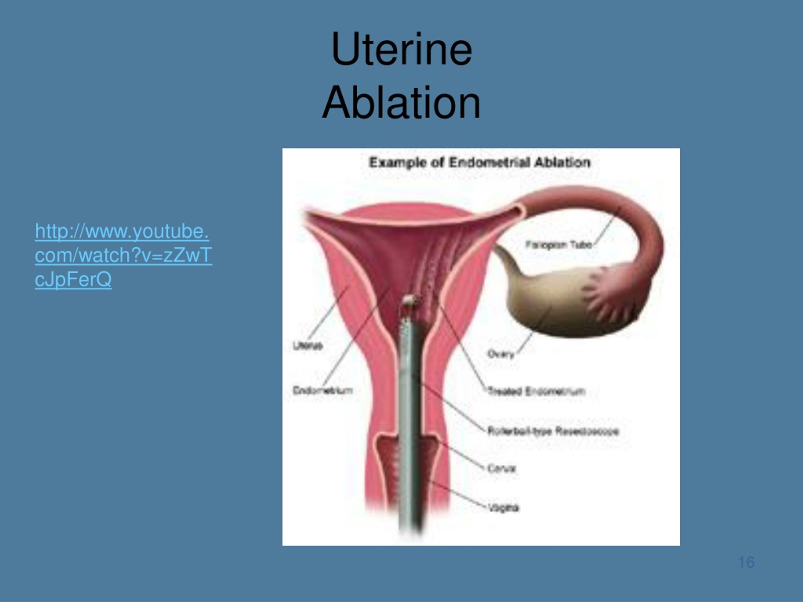 Ablation Of Uterus