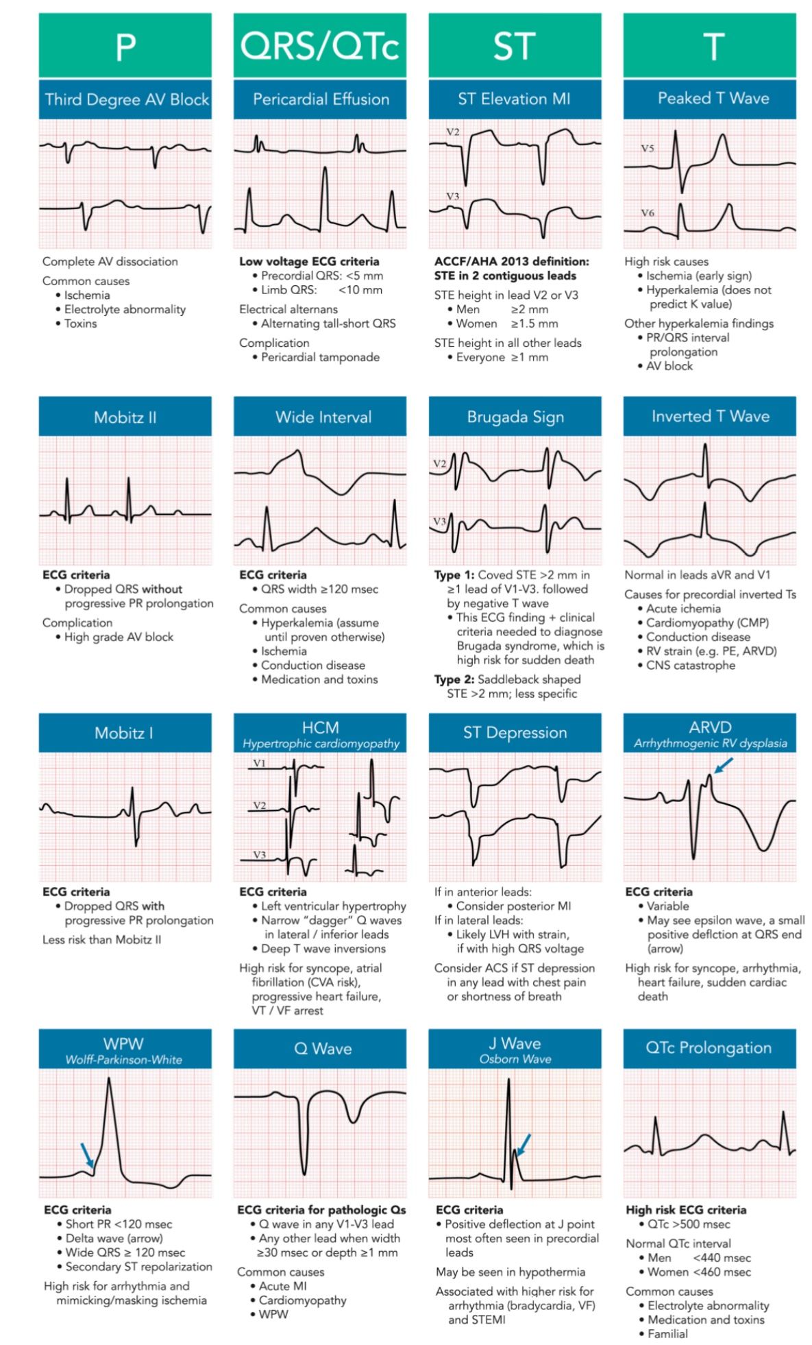 Abnormal Ecg Charts