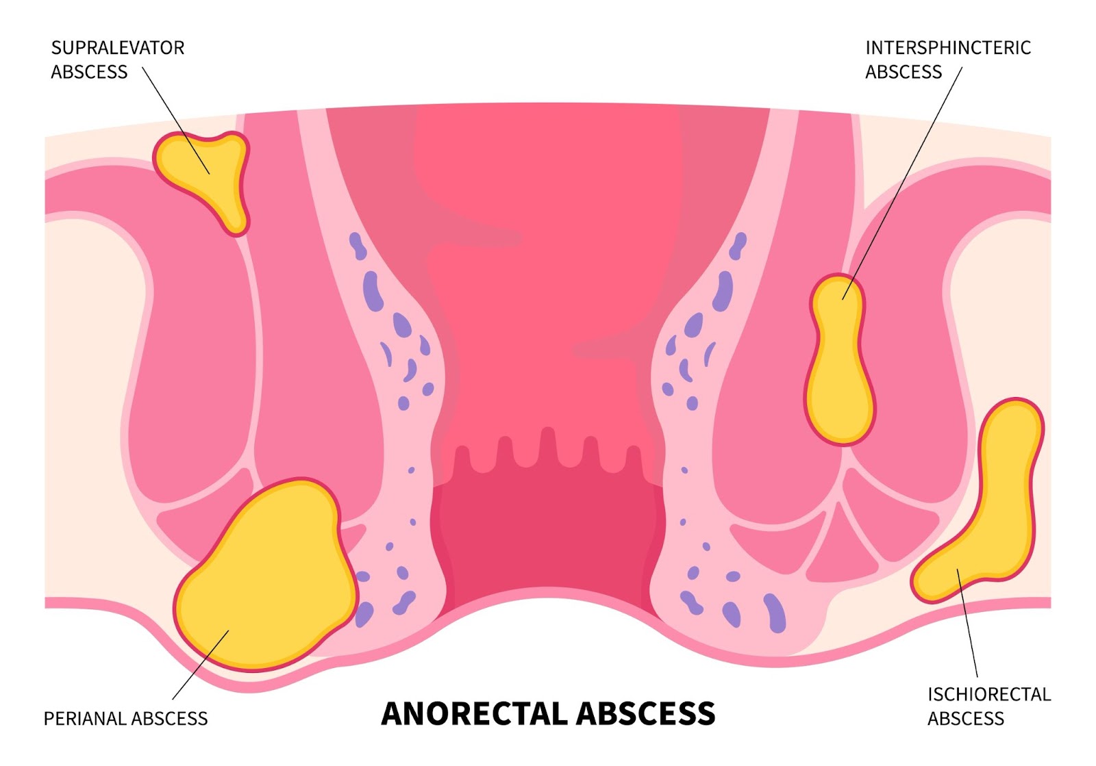 Abscess Inside Buttock