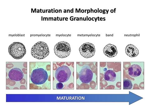 Absolute Immature Granulocyte