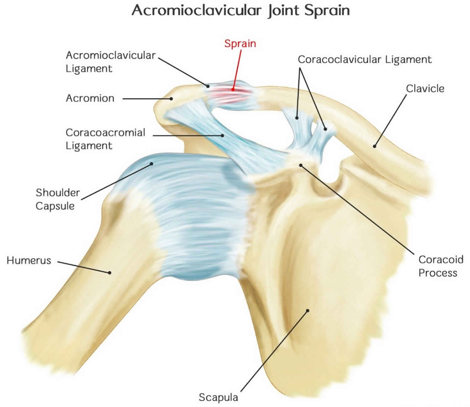 Ac Joint Sprain