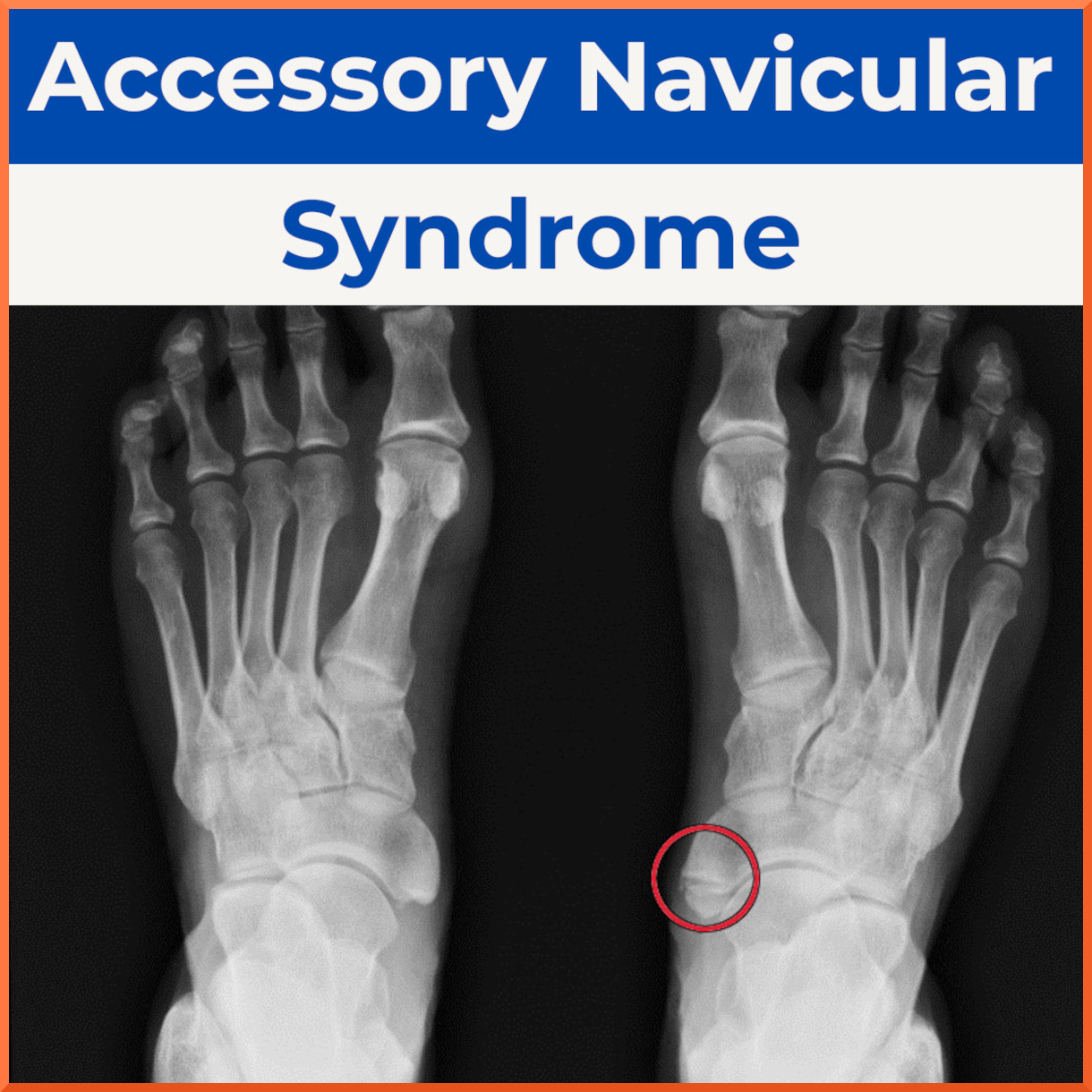 Accessory Navicular Syndrome
