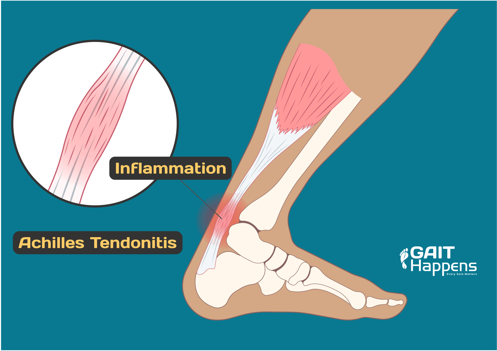 Achilles Tendon Pain Running