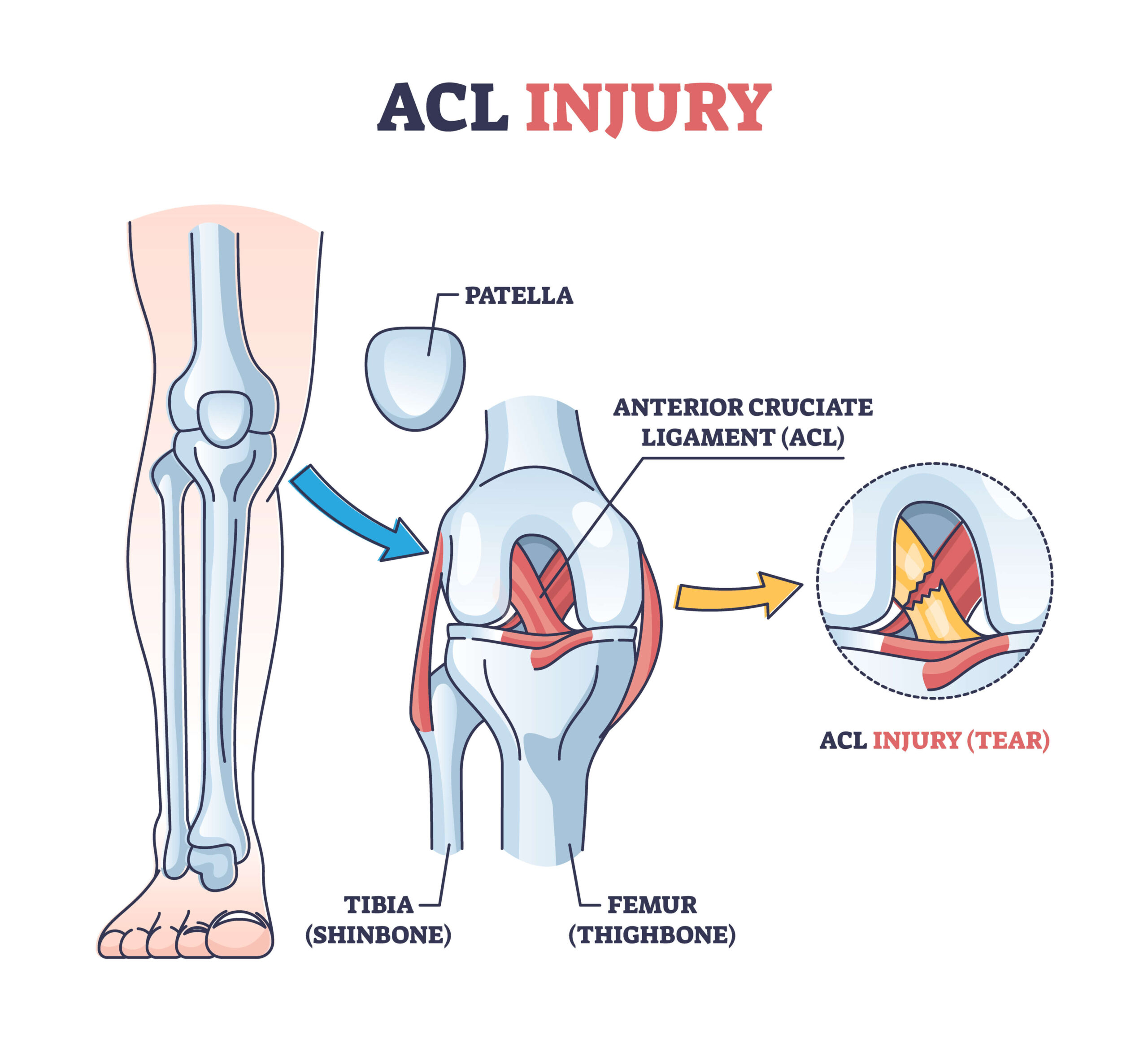Acl Tear Hurt