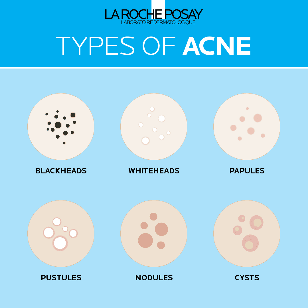 Acne Vs Pimples