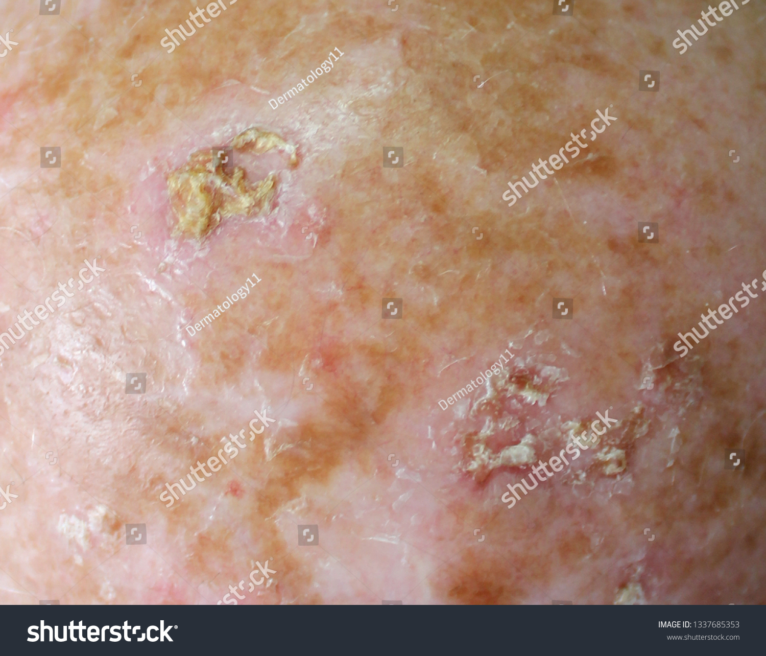 Actinic Keratosis Images