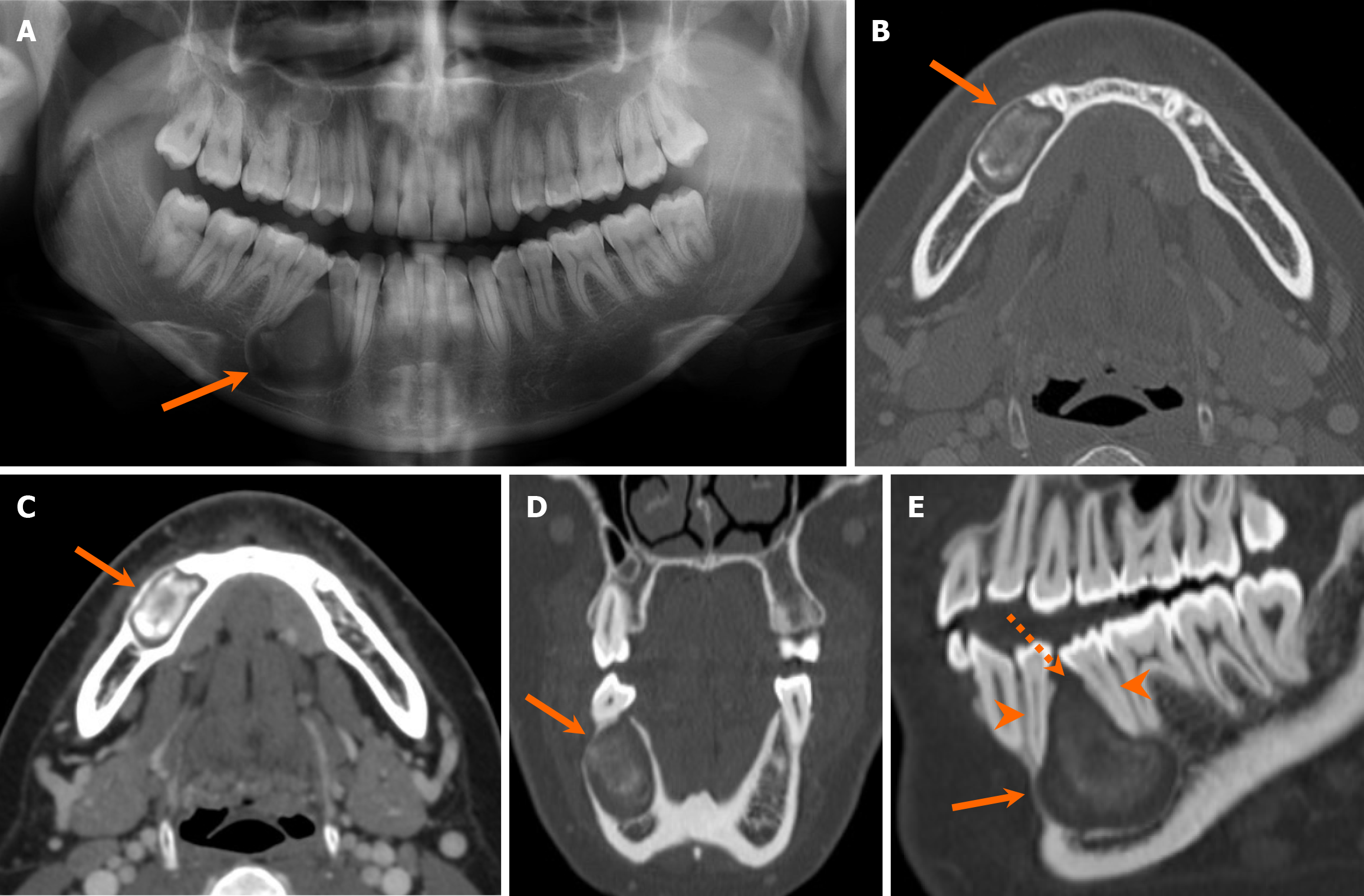 Adenomatoid Odontogenic Tumor