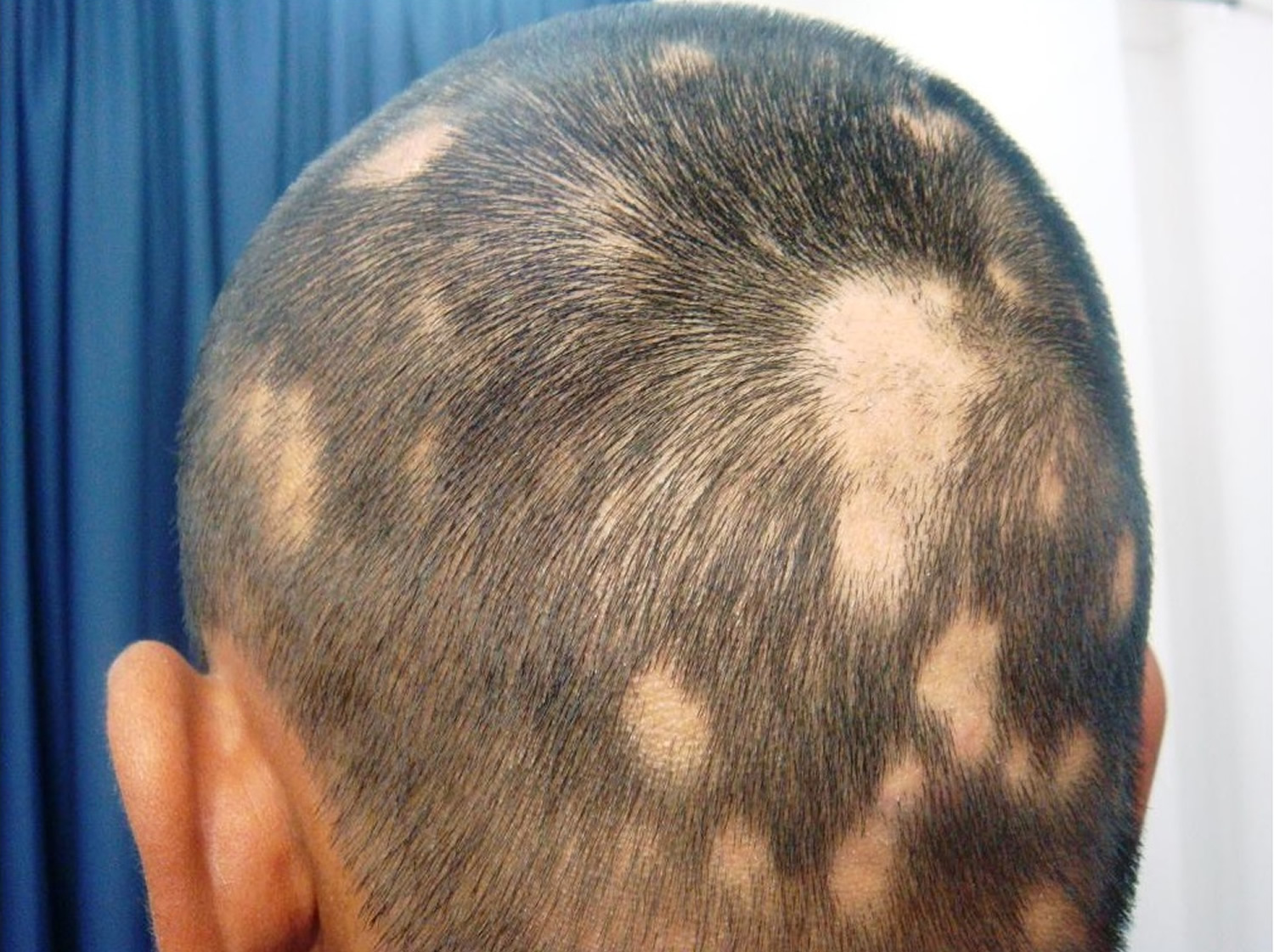 Alopecia Areata Head