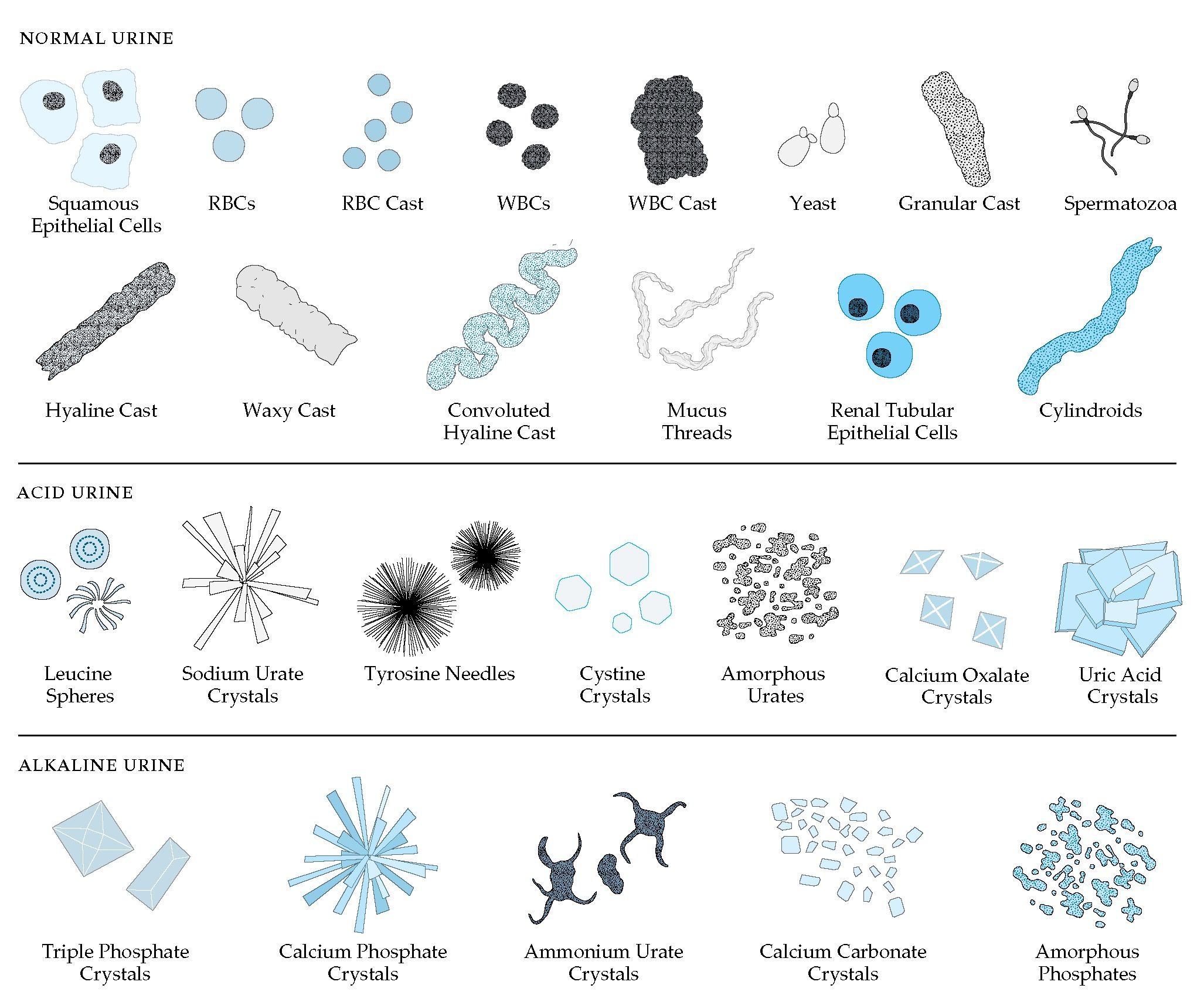 Amorphous Crystals In Urine