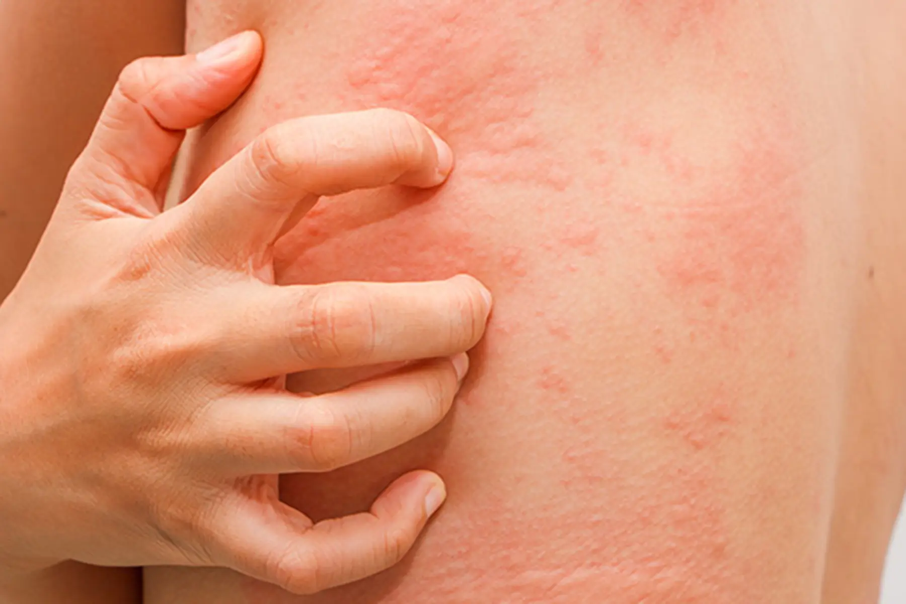 Amoxicillin Skin Rash