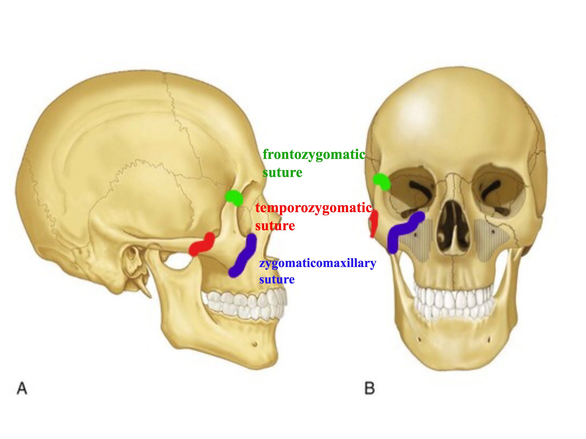 Anatomy Of Zygomaticomaxillary Complex