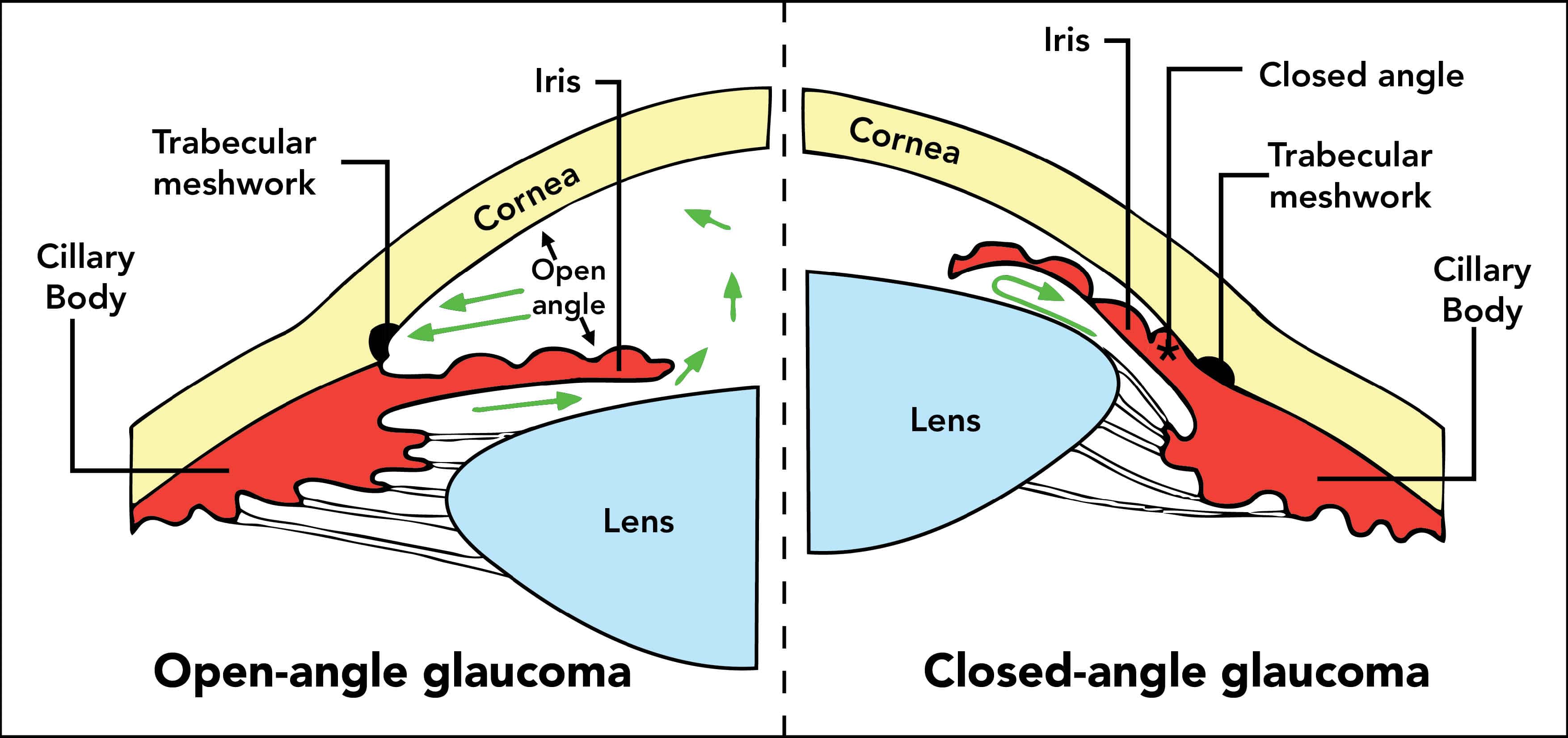 Angle Closure Glaucoma