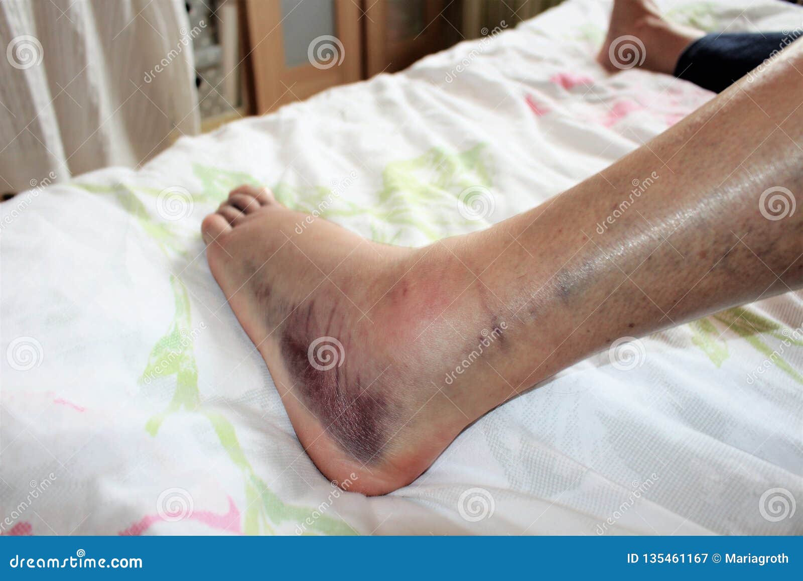 Ankle Break Swelling