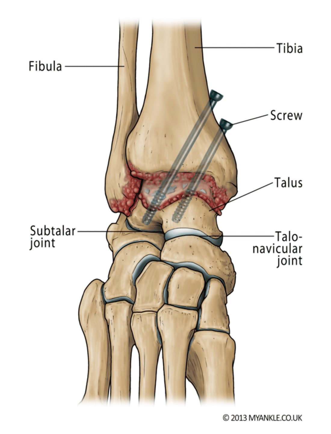 Ankle Fusion Procedures