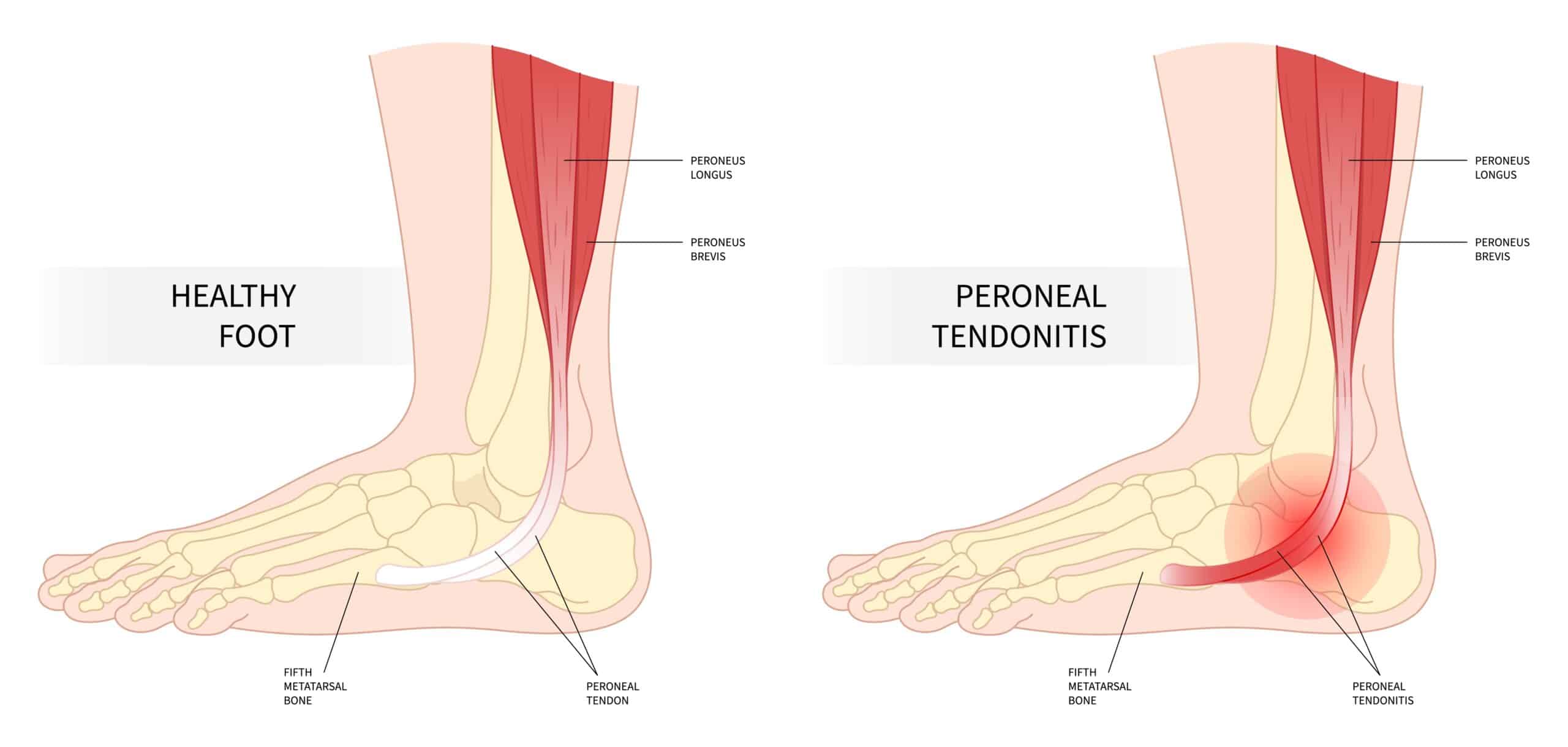 Ankle Tendon Pain