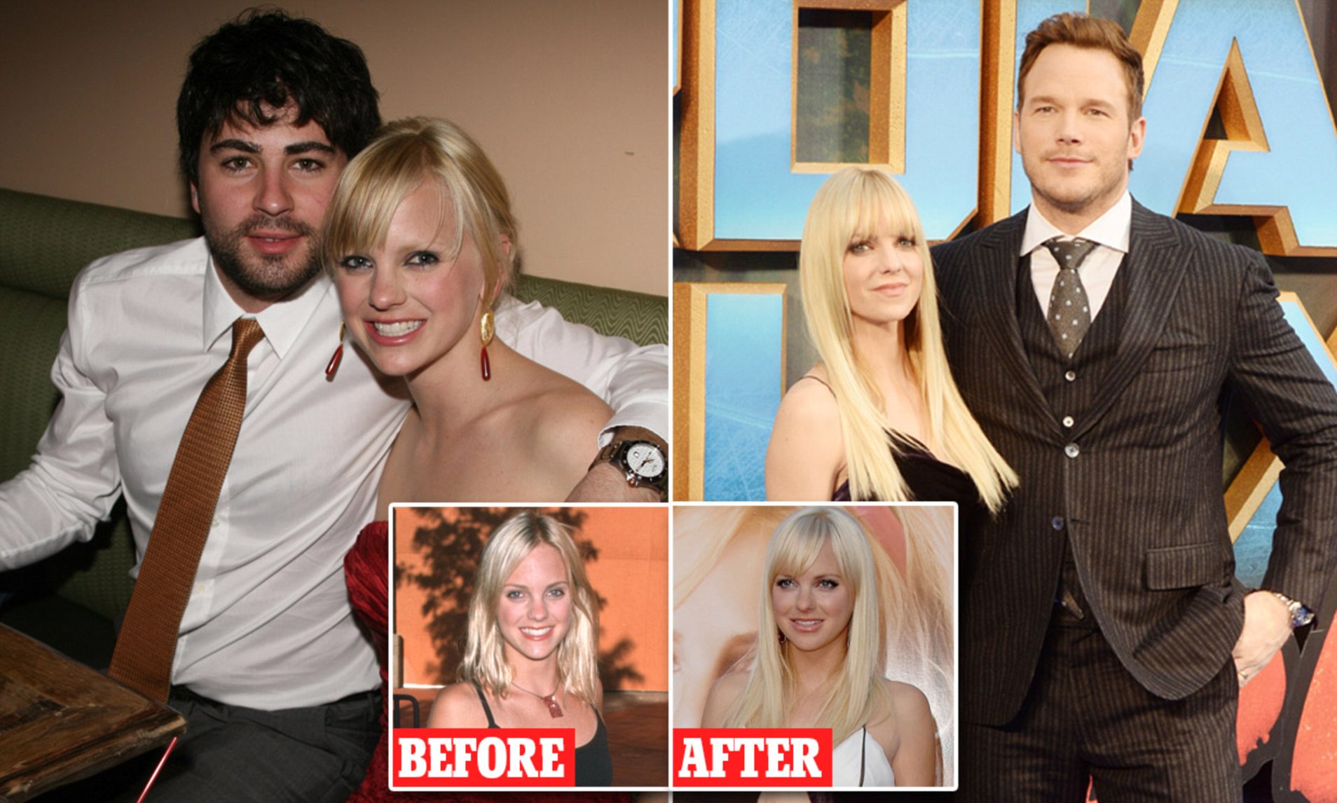 Anna Faris Face Surgery