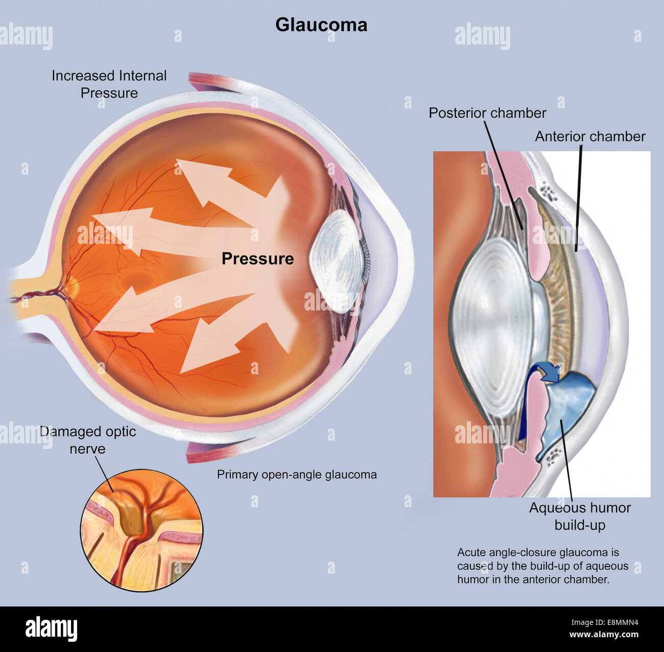 Anterior Chamber Eye