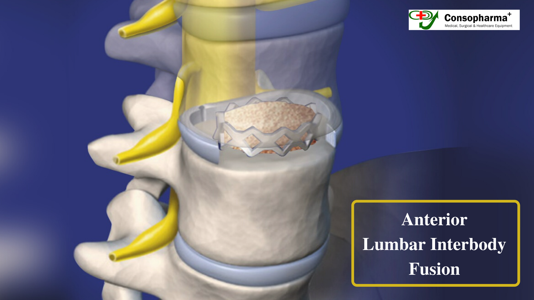 Anterior Lumbar Interbody Fusion