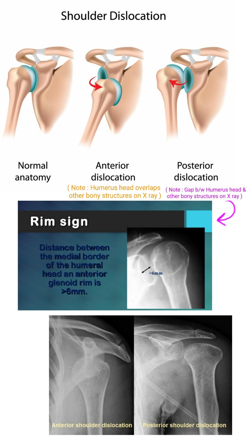Anterior Shoulder Dislocation