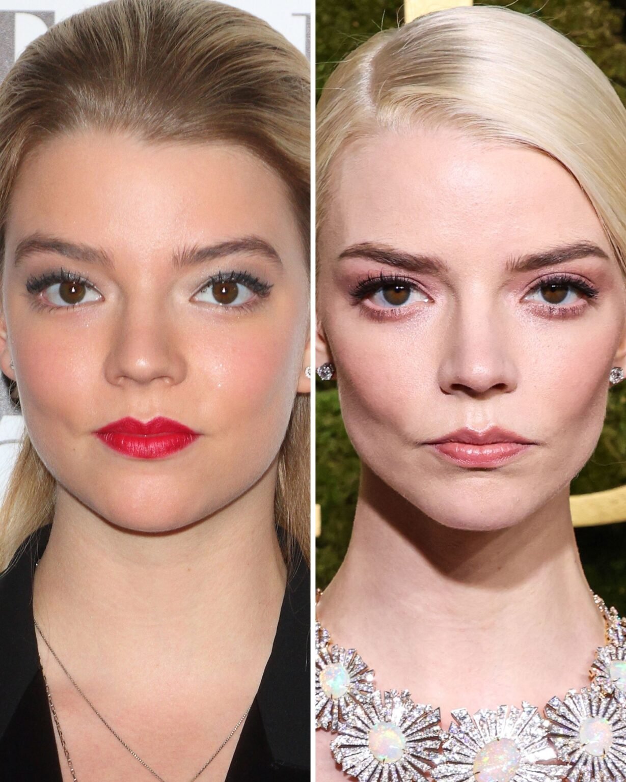 Anya Taylor Joy Face Surgery