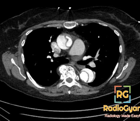 Aortic Dissection Ct