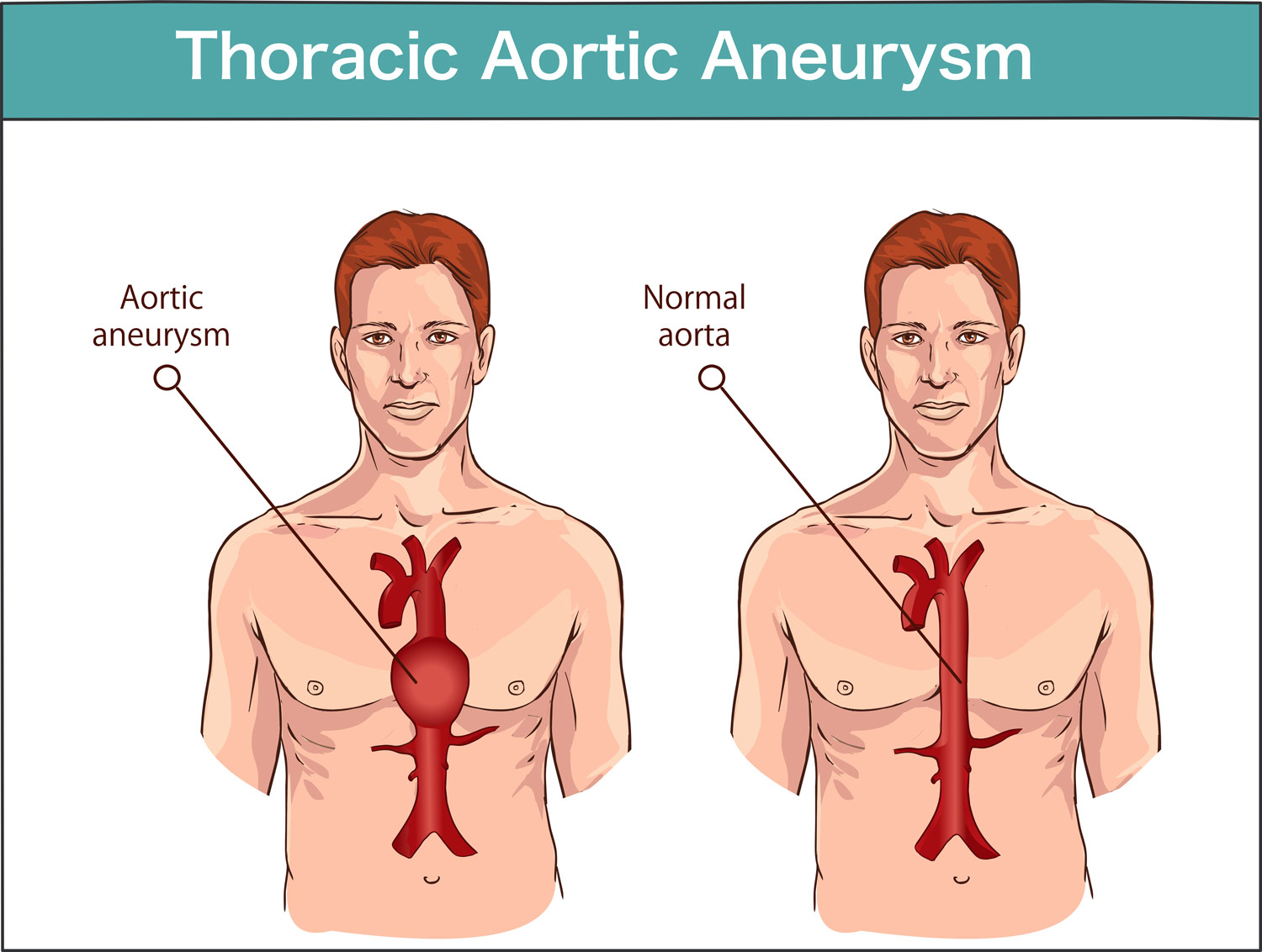 Are Aneurysms Hereditary