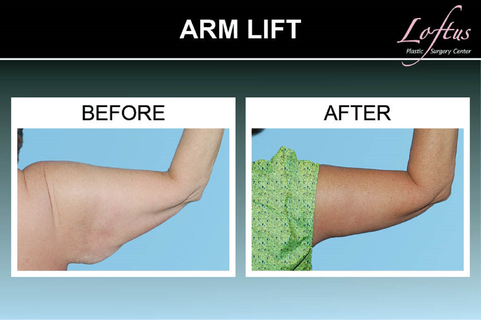 Arm Lift Operation