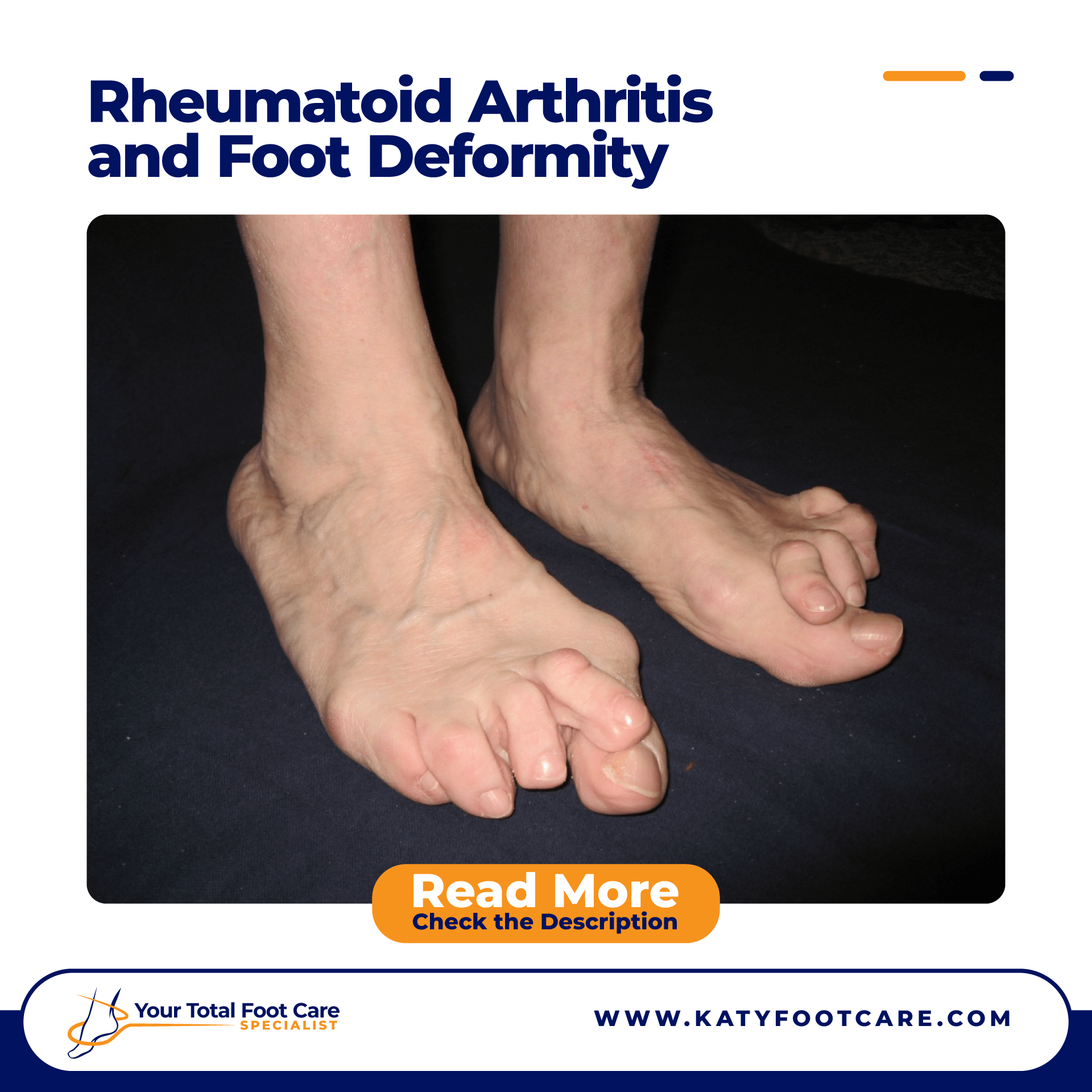 Arthritis And Foot