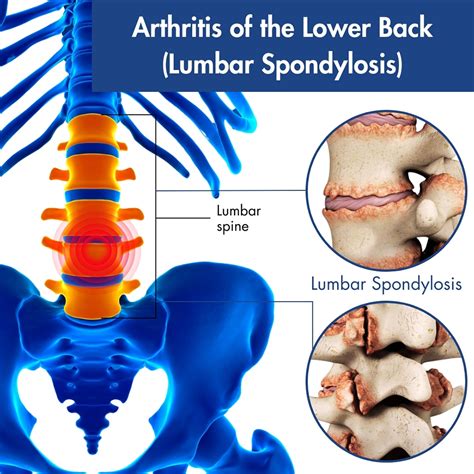 Arthritis In Back