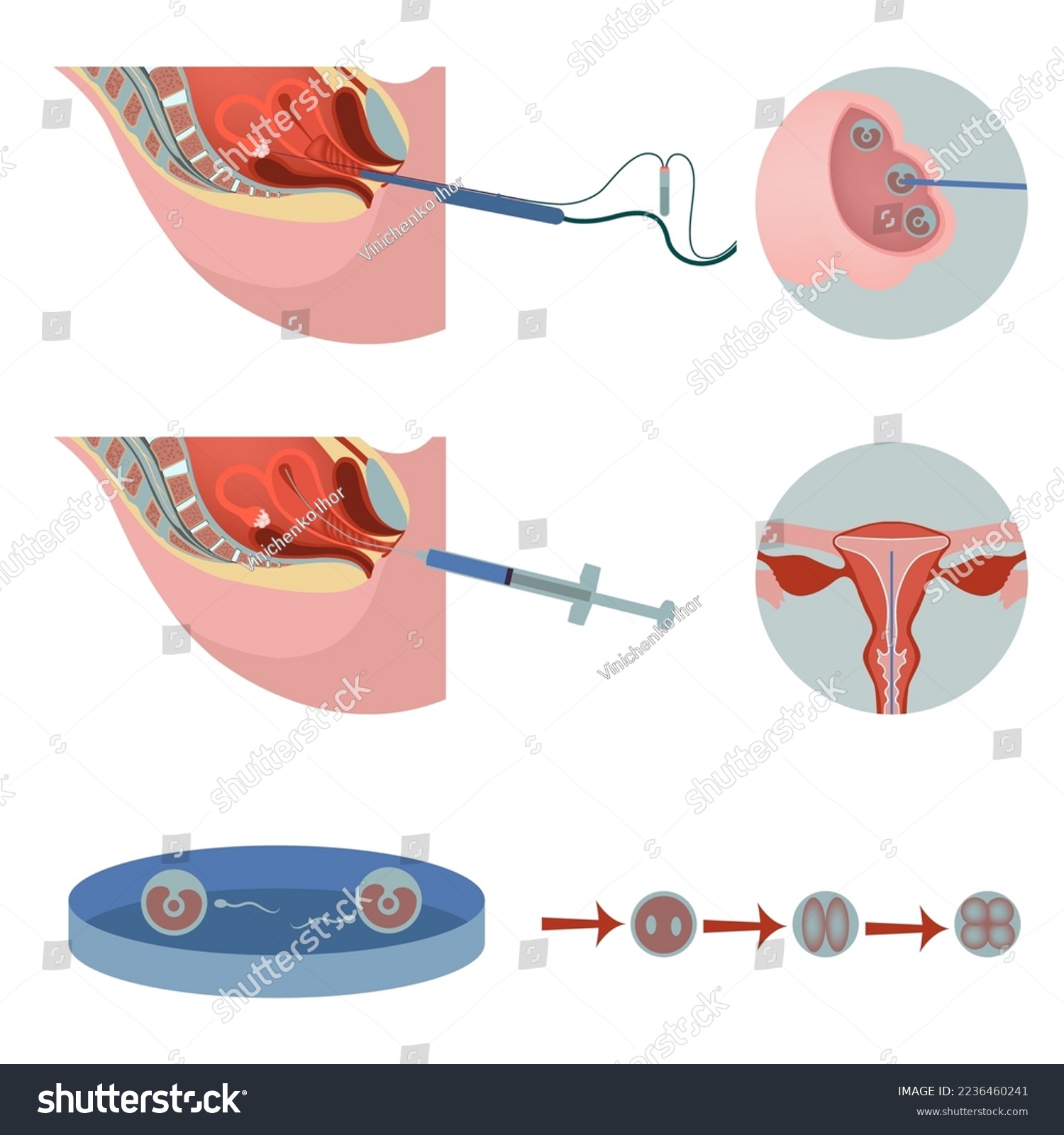 Artificial Insemination Women