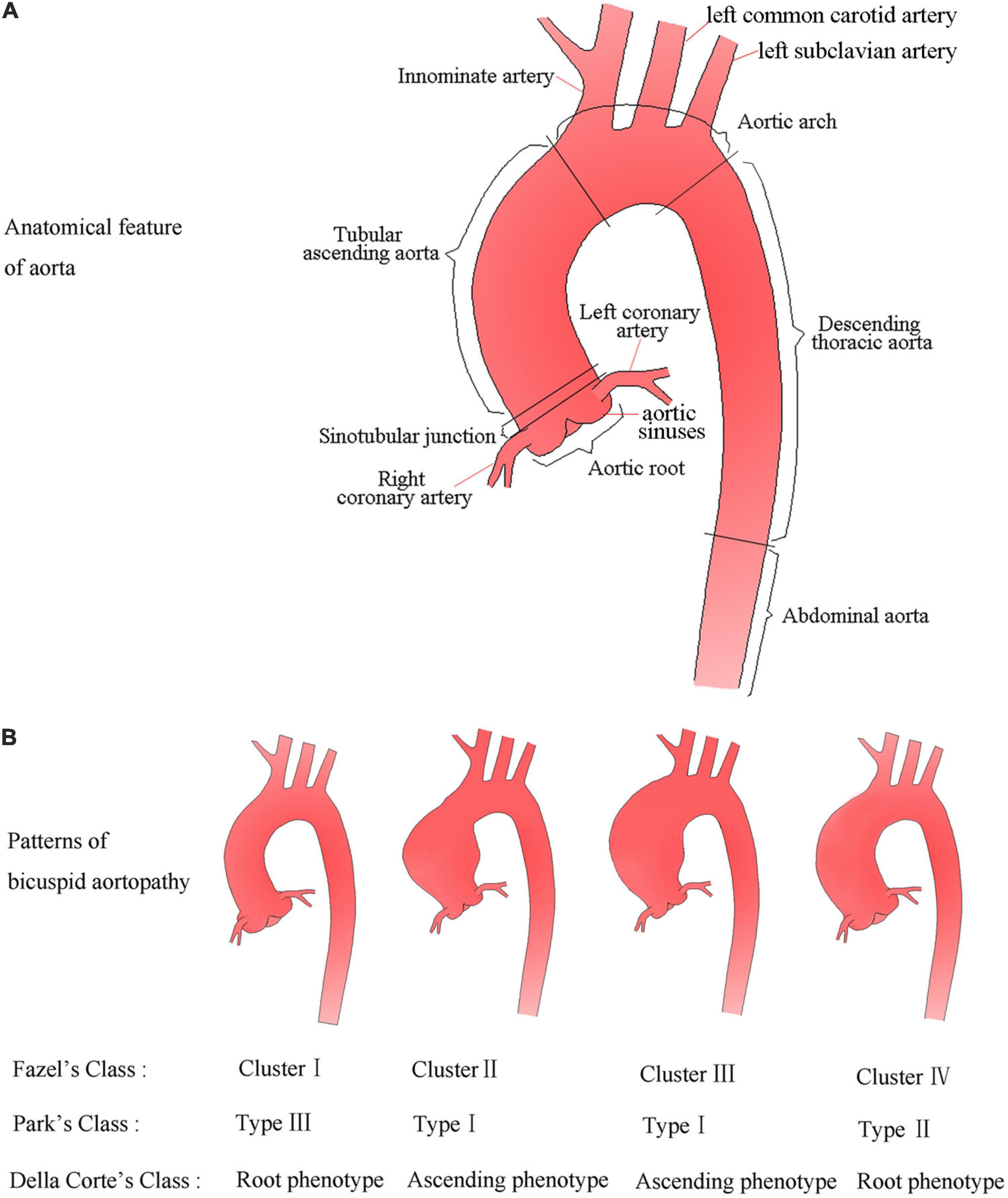 Ascending Aorta Dilatation