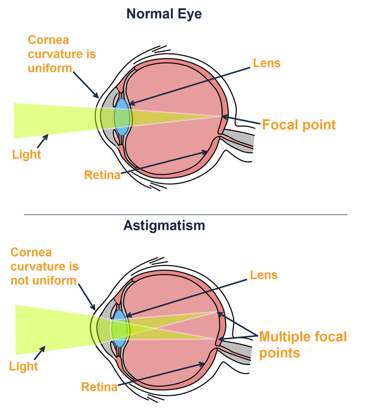 Astigmatism Vs Normal Vision