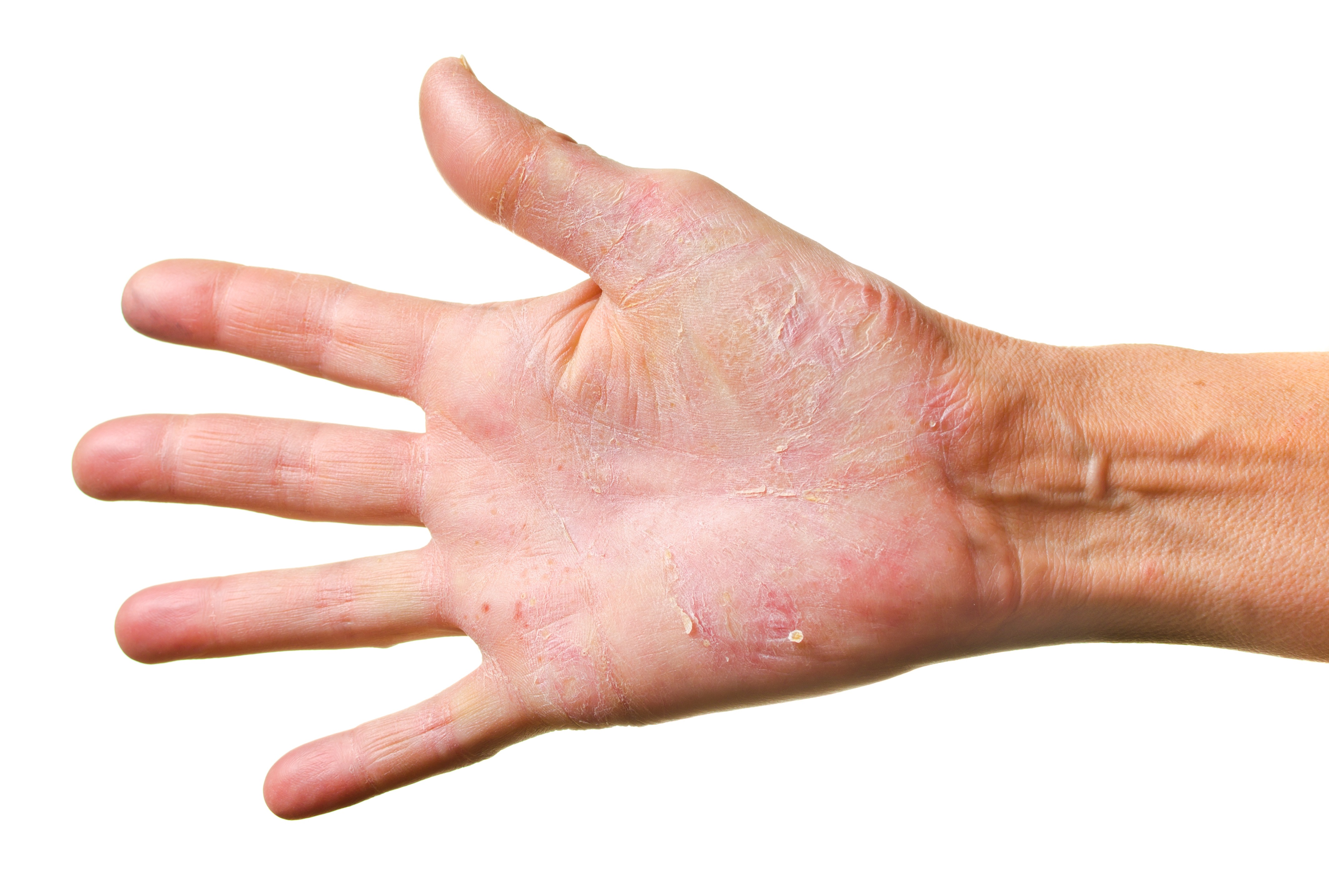 Athlete's Foot Fungus On Hands