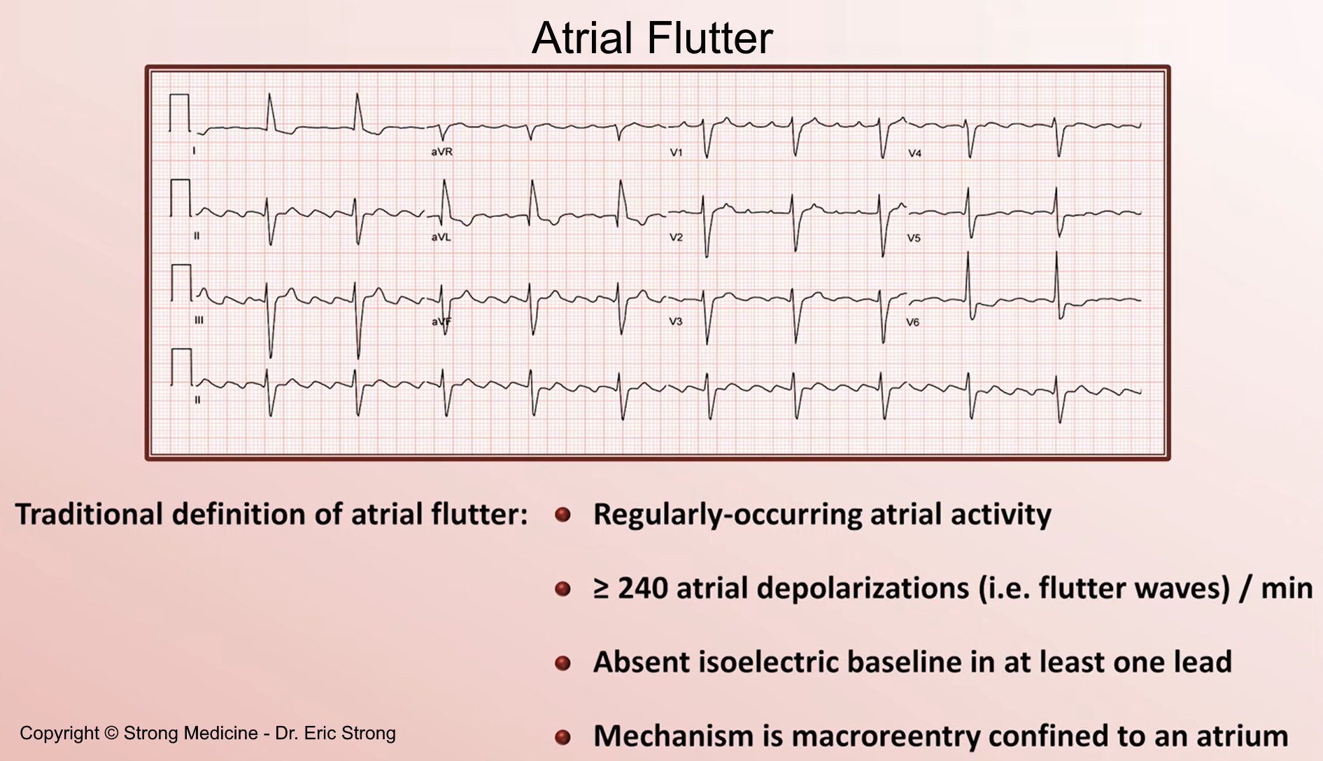Atrial Flutter Ecg