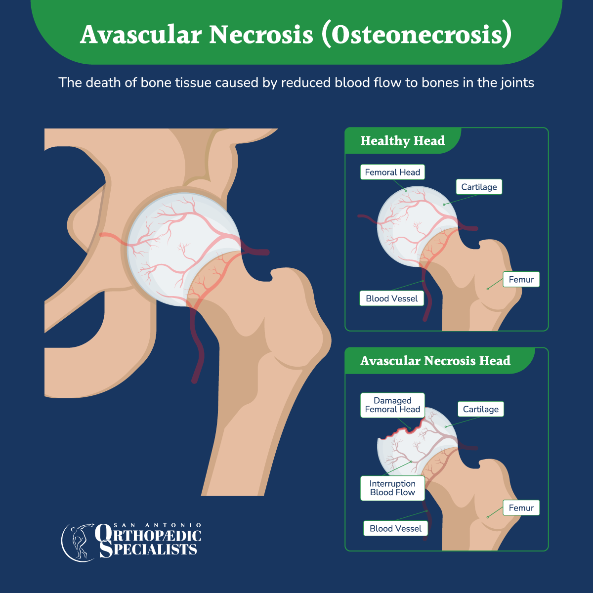 Avascular Necrosis Symptoms