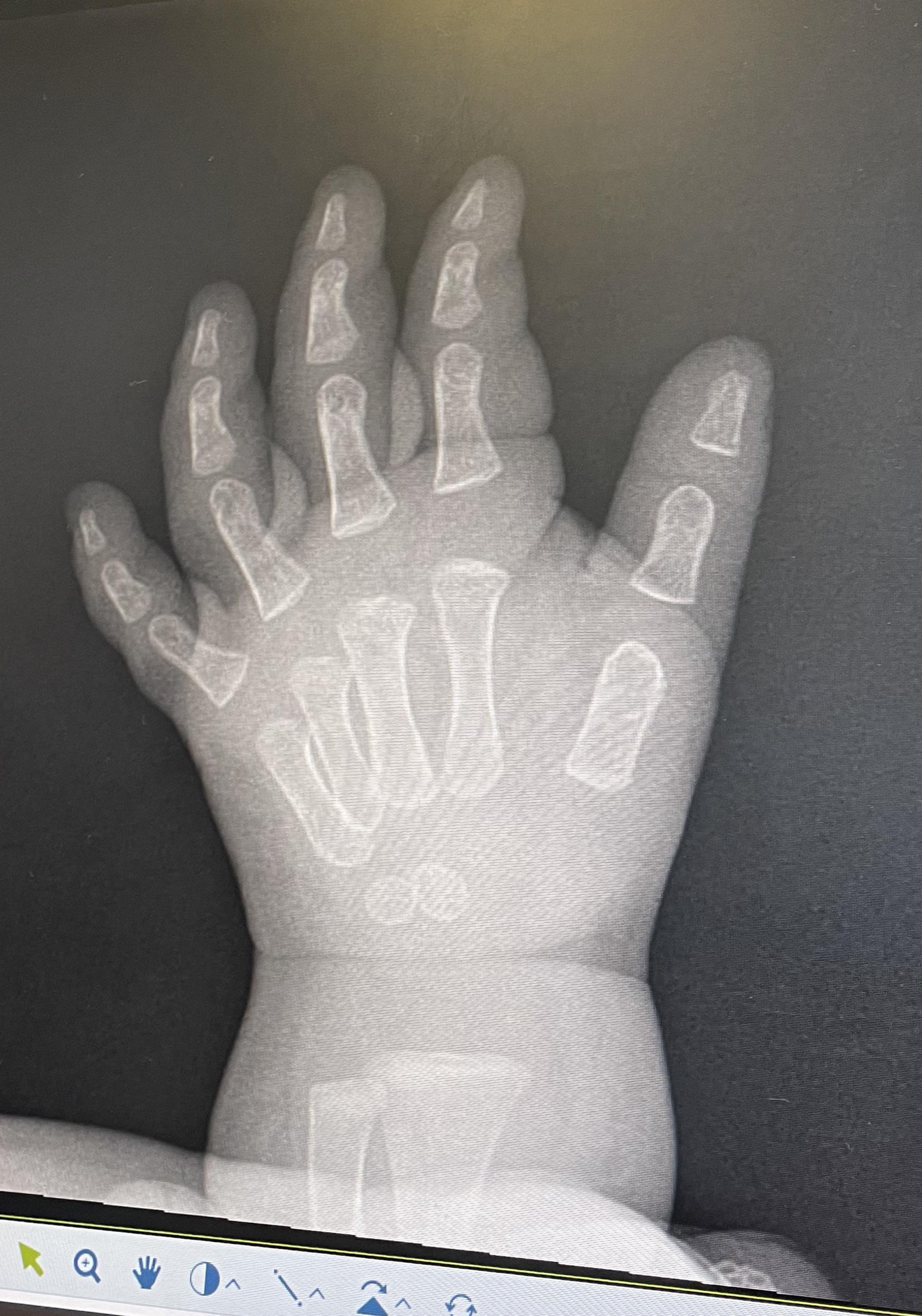 Baby's Hand X Ray