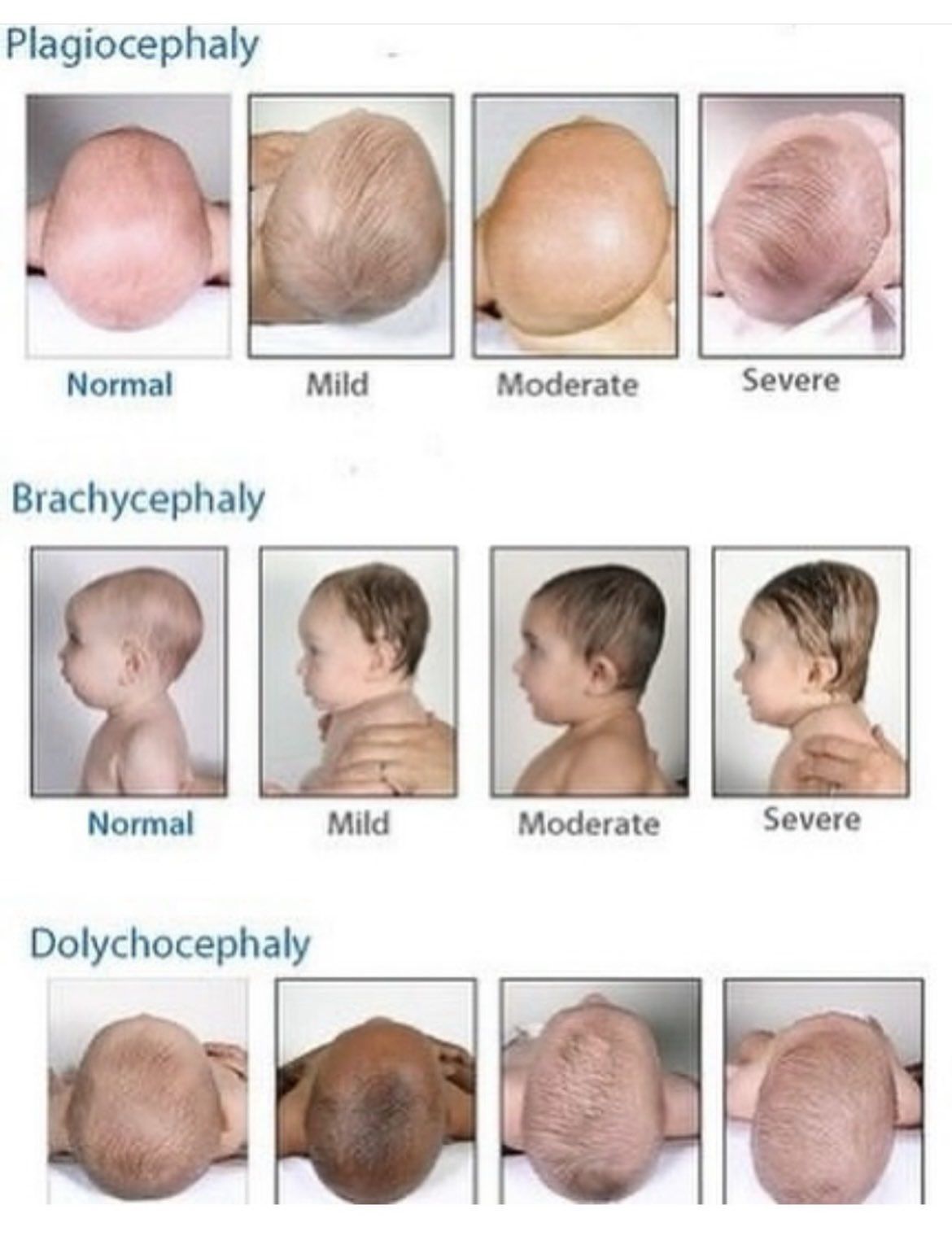 Baby's Head Shape