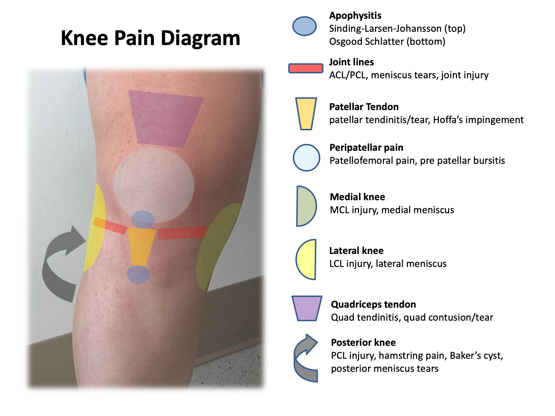 Back Of Knee Pain