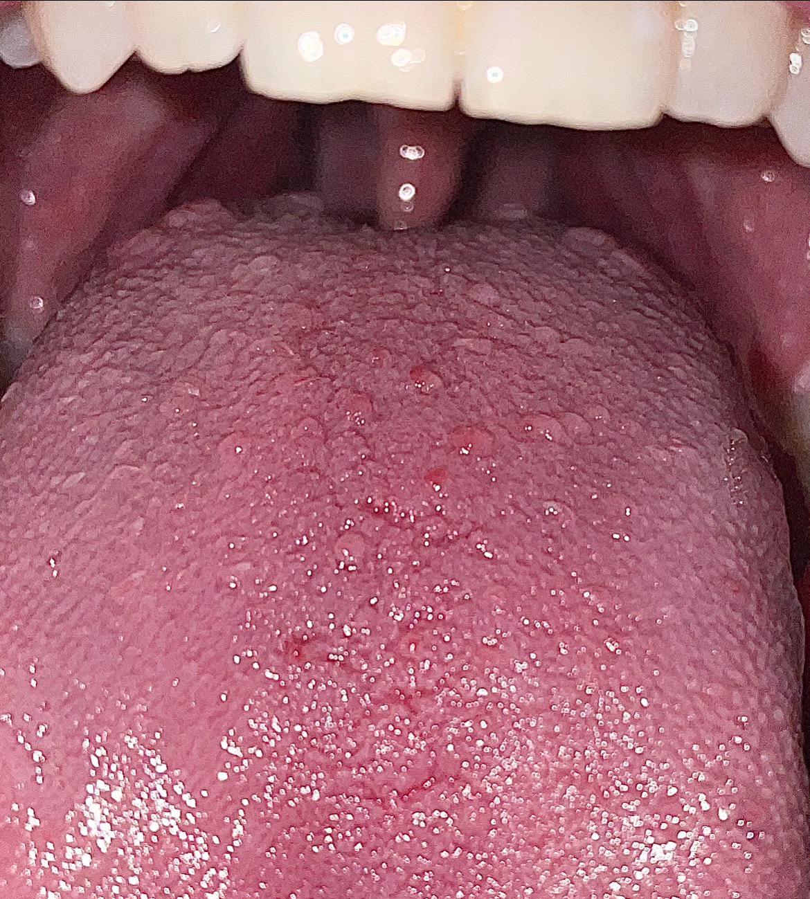 Back Of Tongue Spots