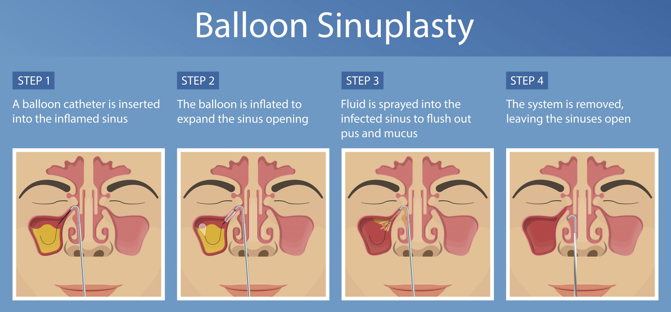 Balloon Sinus Dilation