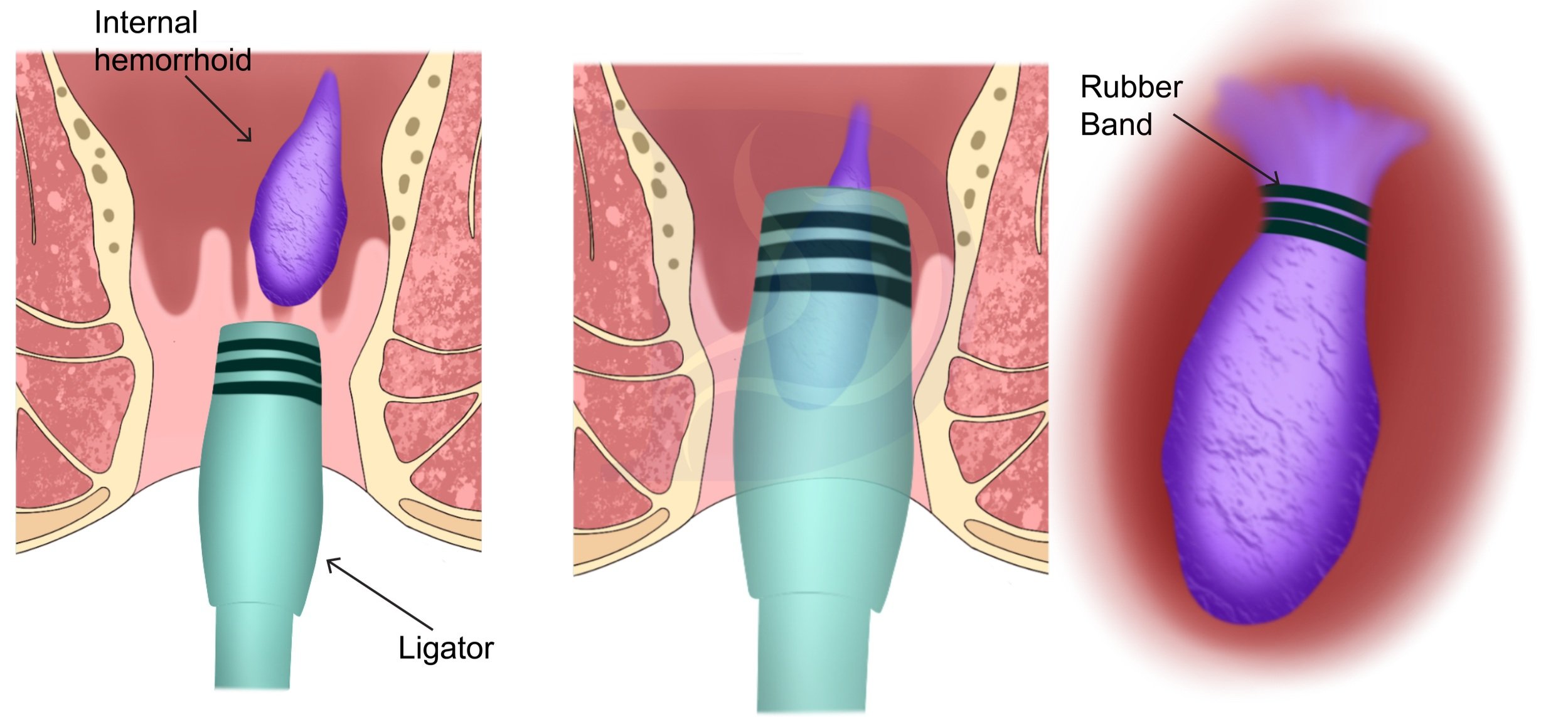 Banding Of Hemorrhoids